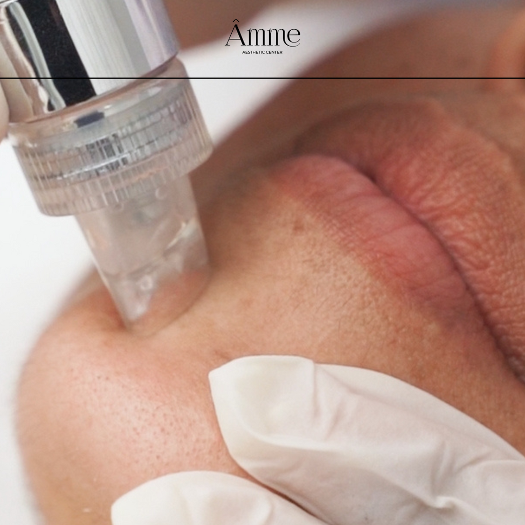 4 razones por las que deberías probar el tratamiento Hydrafacial