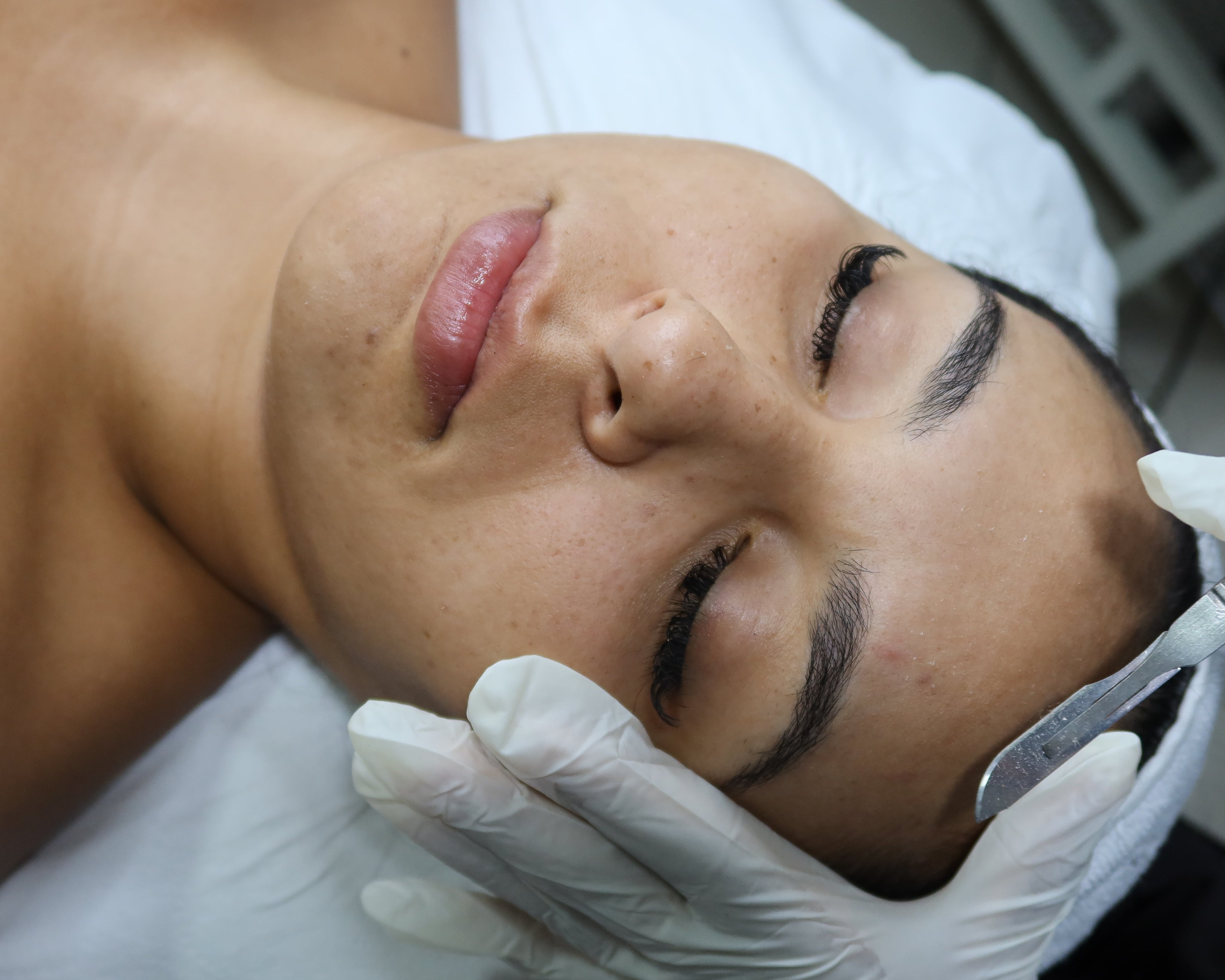 Dermaplaning
