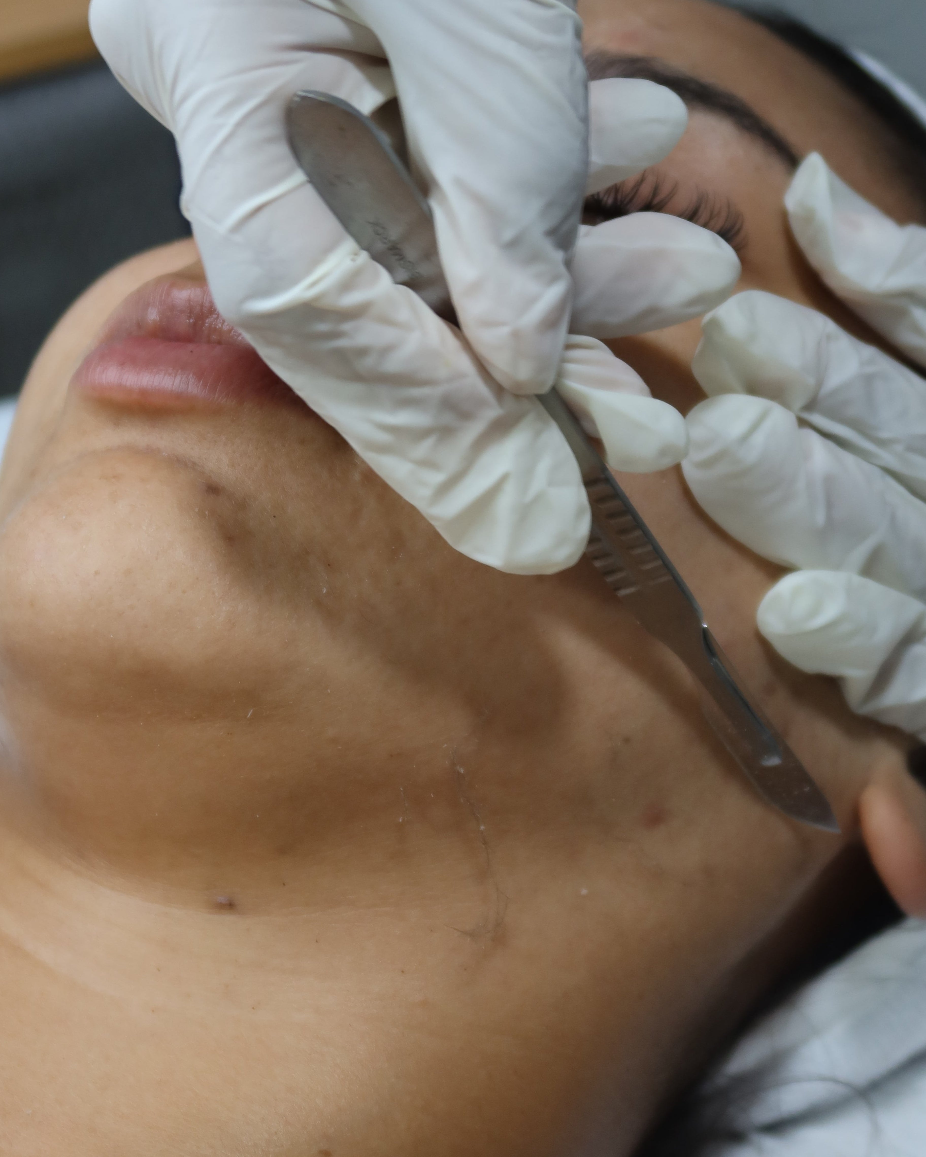 Dermaplaning