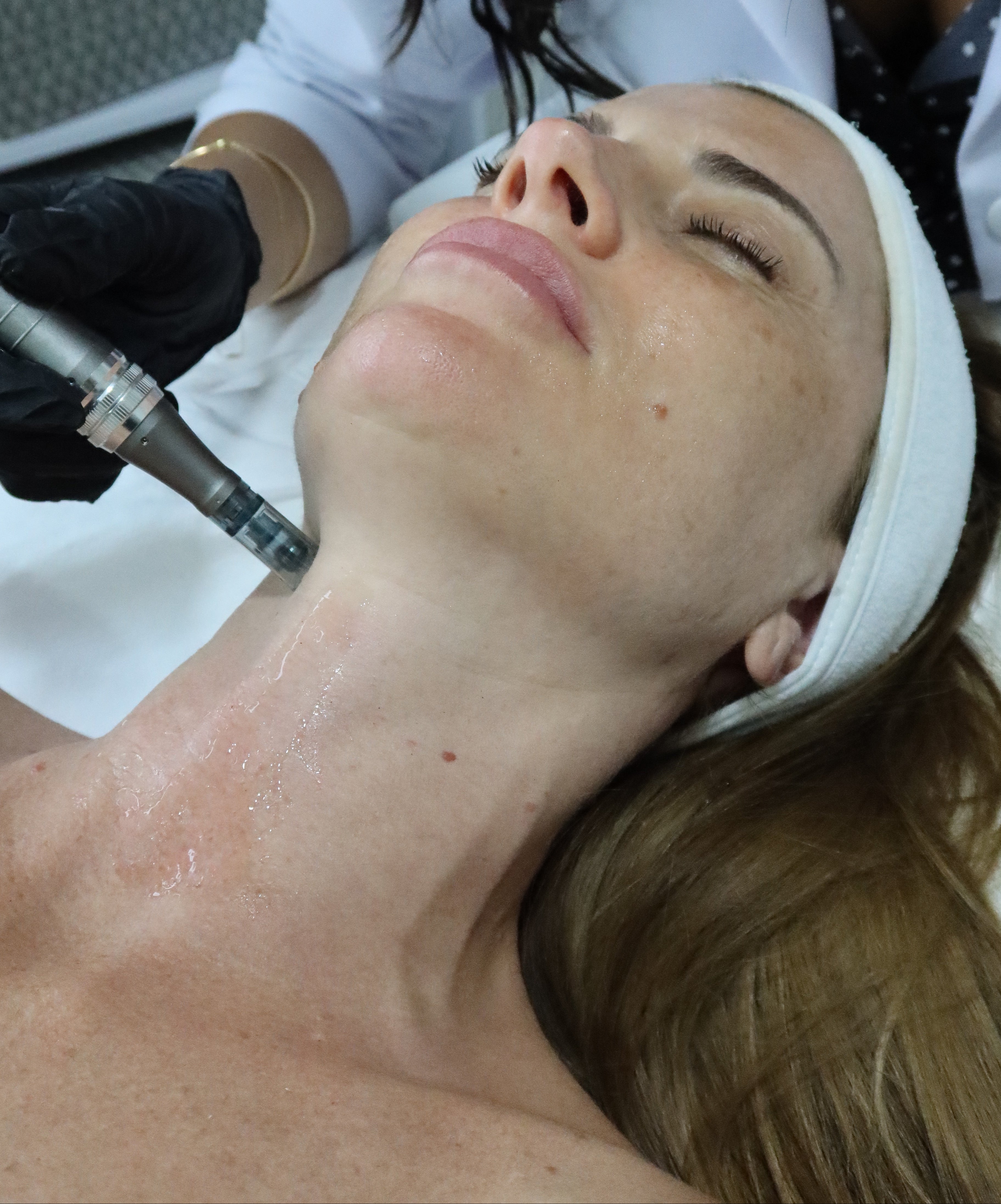 Microneedling (dermapen)